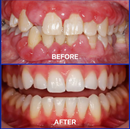 BeeRenew Advanced Gum Healing