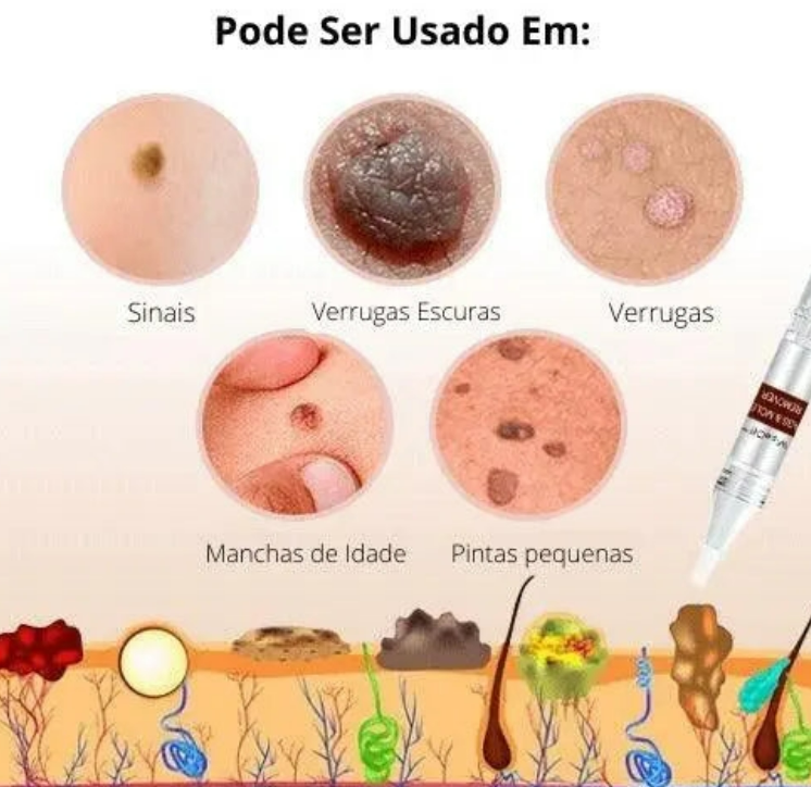 ЕХТЕRМIΝАDОR DЕ VERRUGAS E PINTAS  - ENTREGA EXPRESSA