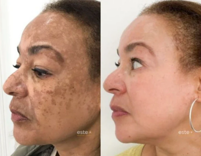 Revitta 577 Spray - Remove manchas de SOL, IDADE E MELASMA!