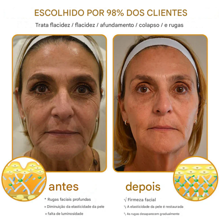 Creme removedor de rugas Botox Bee Venom - 🐝 Promoção relâmpago: só hoje!