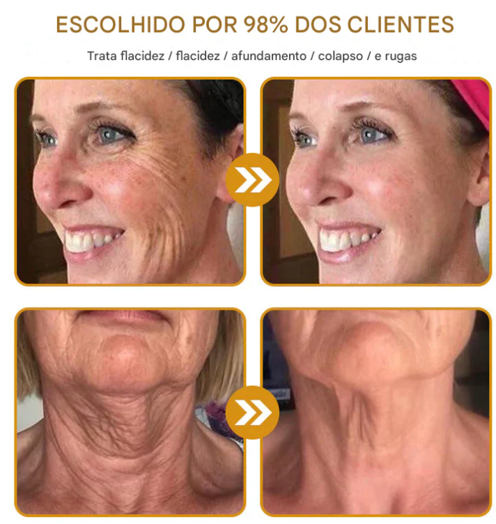 Creme removedor de rugas Botox Bee Venom - 🐝 Promoção relâmpago: só hoje!
