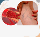 VARICOSE VEINS