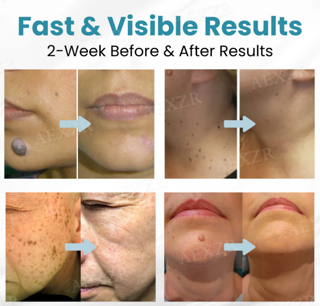 CANETA LASER BIKENDA
